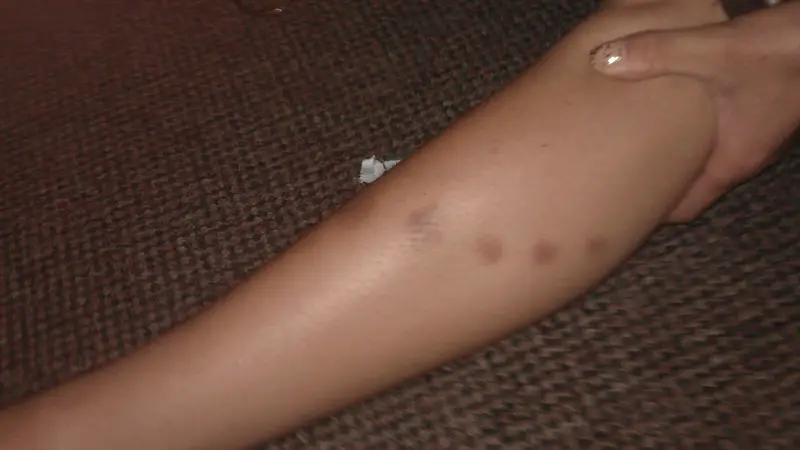  Leg bruises from pole dancing