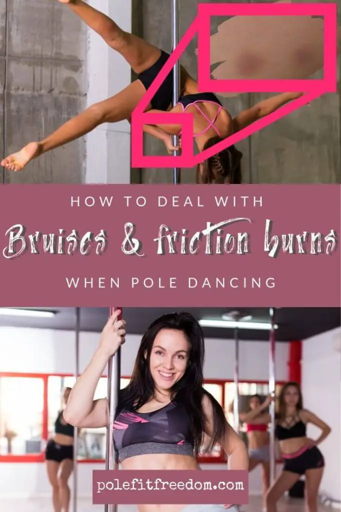 How to treat pole dancing bruises, friction burns and injuries